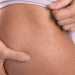 Rid Stretch Marks