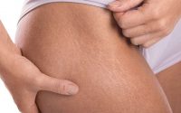 Rid Stretch Marks