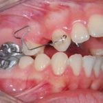 Space Closure in Orthodontics