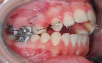 Space Closure in Orthodontics