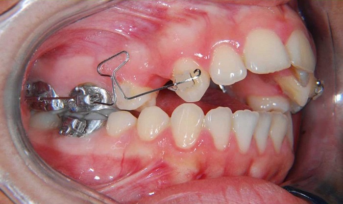 Space Closure in Orthodontics